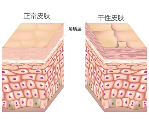正常皮肤和干性皮肤角质层对比