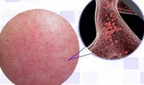 消除脸上红血丝的小妙招插图(1) 消除脸上红血丝的小妙招插图(1)