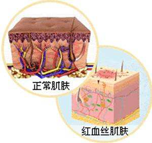 肌肤敏感红血丝和内调的关系插图(1)