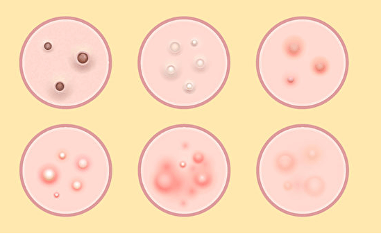 粉刺痘痘形成的原因及保养方法插图