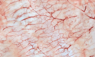 皮肤出现红血丝，小心敏感肌找上门插图
