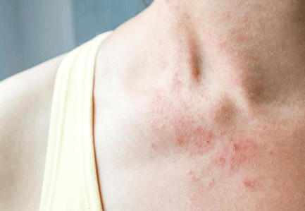 温差大容易发作，如何应对异位性皮肤炎？