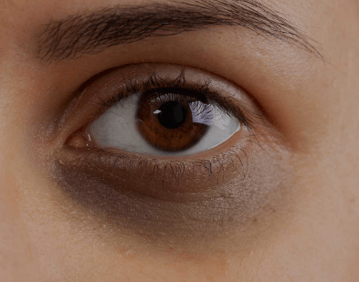 黑眼圈怎么区分色素型和血管型？