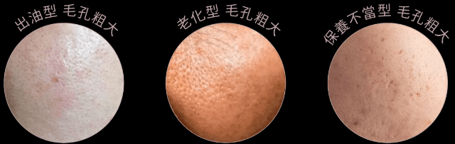 三招收缩毛孔,解决毛孔粗大烦恼插图(1) 三招收缩毛孔,解决毛孔粗大烦恼插图(1)