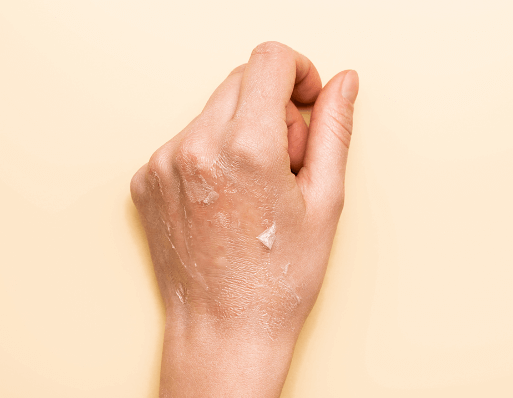 身体皮肤干燥脱皮改善及预防措施插图