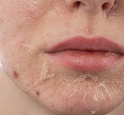 关于脸脱皮的急救指南：晒伤和缺水