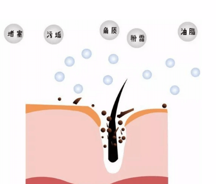 了解痘痘形成的原因及处理方法插图(1) 了解痘痘形成的原因及处理方法插图(1)