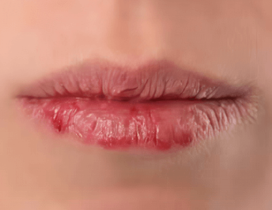 唇炎是怎么导致的？“口红”或是主因插图