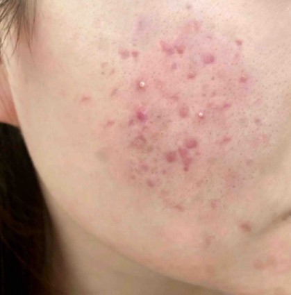 换季长痘如何护理？插图