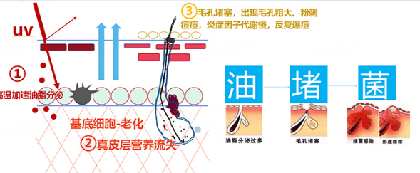 痘痘肌能用带酒精的护肤品吗插图(1) 痘痘肌能用带酒精的护肤品吗插图(1)