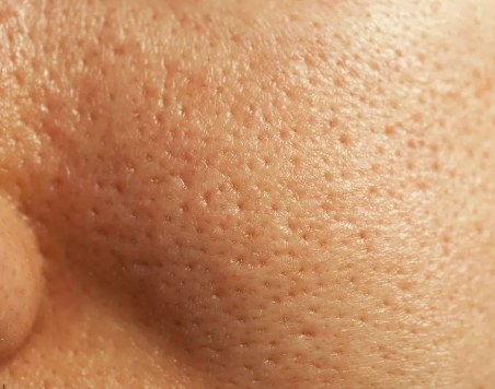 如何改善肌肤的毛孔粗大问题？