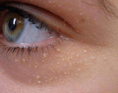 眼周长脂肪粒，都是由眼霜造成的？