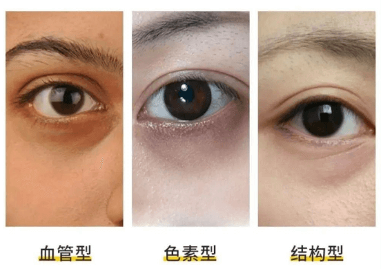 不同类型黑眼圈的“对症”方法