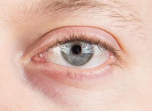 如何有效去除血管性黑眼圈？