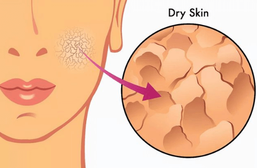 干性皮肤：分为缺水型和缺油型