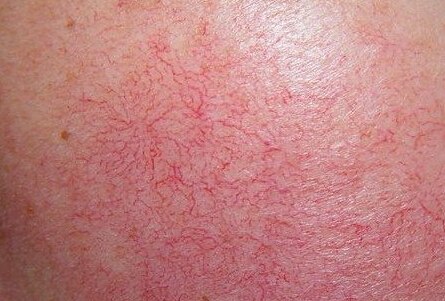 皮肤在什么情况下容易出现红血丝？