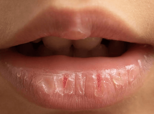 嘴唇干燥脱皮是缺什么？