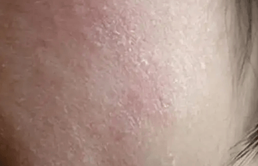 干皮和油皮的区别及护肤要点插图 干皮和油皮的区别及护肤要点插图