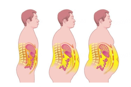 为什么肥胖容易出现脂肪肝？插图