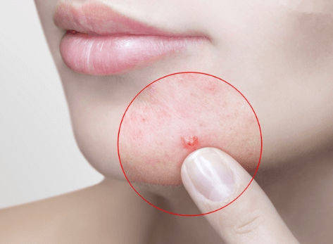 脸部泛红起痘痘是什么原因导致的？