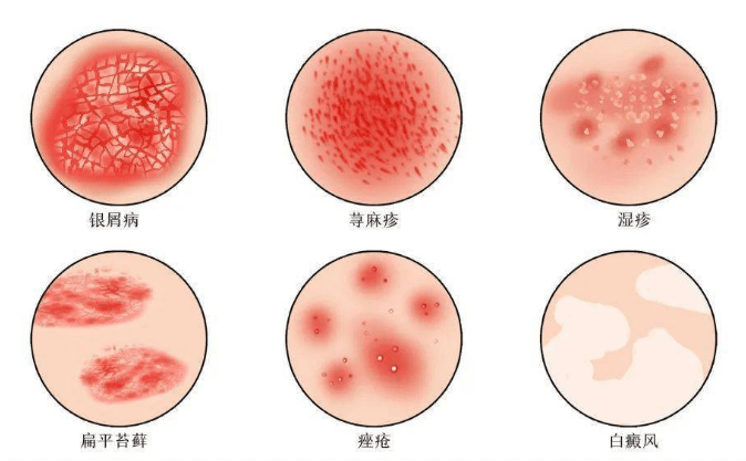 痤疮和湿疹的区别是什么插图