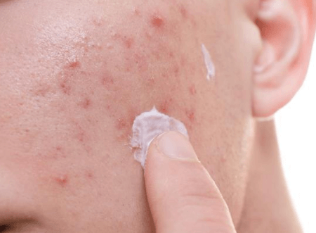 混合肌经常长痘痘，是属于油痘肌吗?