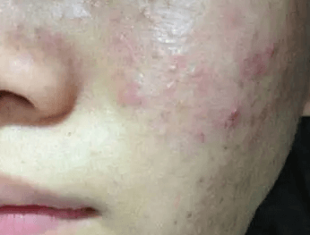 脸颊痘痘反复长是什么原因引起的