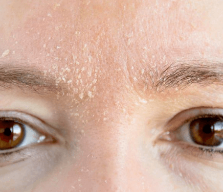 洗脸后皮肤干燥起皮是什么肤质
