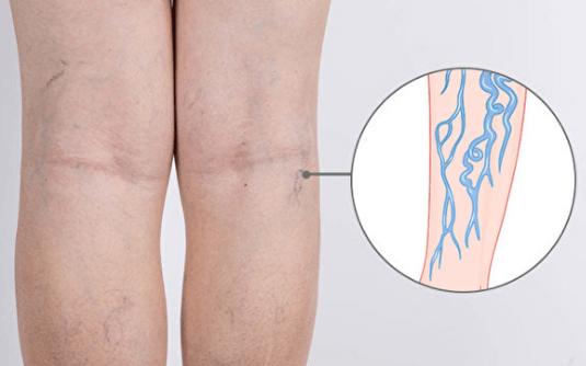 大腿静脉曲张形成原因及缓解办法
