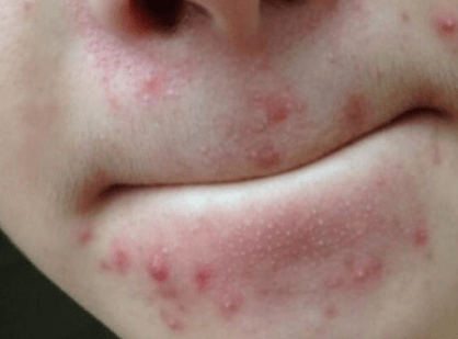 嘴巴周围长痘痘是什么原因引起的插图
