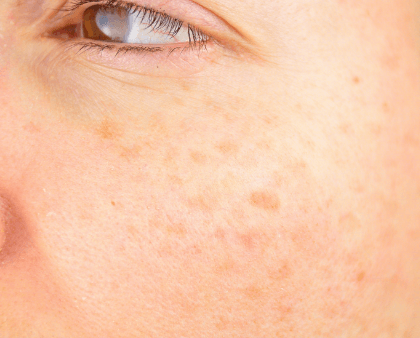 为什么干性皮肤容易长斑和细纹
