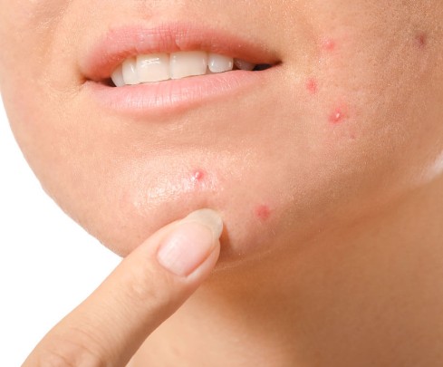 长痘是皮肤清洁不够导致的吗