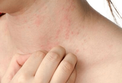 皮肤过敏是不是身体有什么问题插图