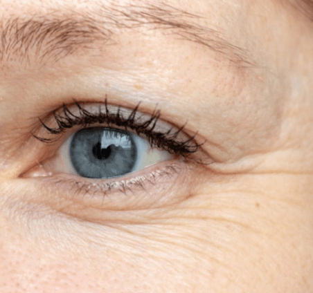 眼角的细纹怎么淡化