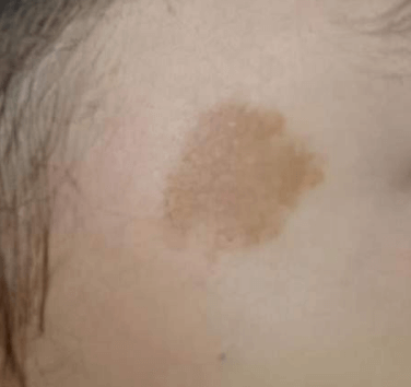 咖啡斑是遗传的吗？其形成原因分析