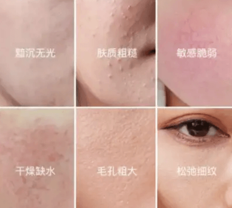 皮肤屏障受损反复长痘怎么办