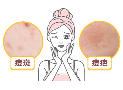 挤完痘痘后怎么处理才不会留疤？插图