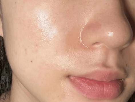 油皮闭口肌肤|简化护肤才是硬道理插图 油皮闭口肌肤|简化护肤才是硬道理插图