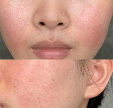 脸部皮肤经常泛红该如何解决？
