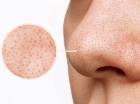 角质层受损会毛孔粗大吗？