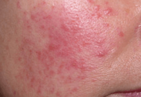 一热就脸红是角质层薄吗插图 一热就脸红是角质层薄吗插图