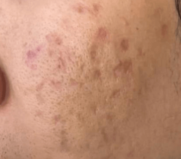 淡斑与祛痘印，你真的分清了吗？插图(1)