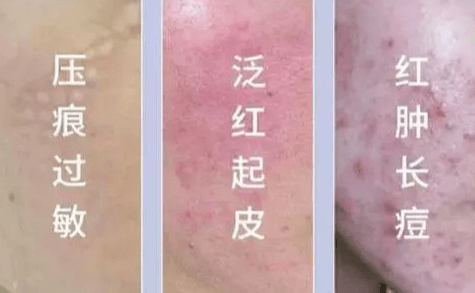 为什么维持健康皮肤屏障很重要?插图