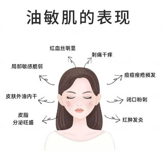 如何告别油光痘痘?油皮敏感肌必看! 如何告别油光痘痘?油皮敏感肌必看!