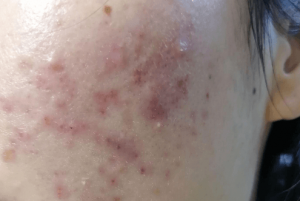 油性皮肤脸上起满痘痘怎么办