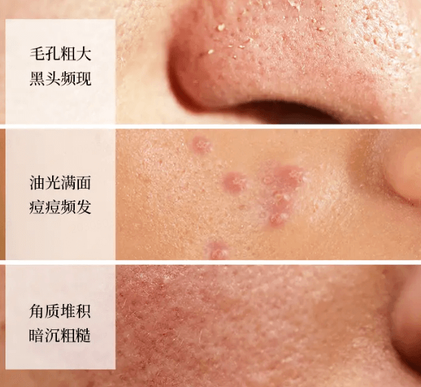 刷酸护肤：焕肤神器还是毁肤利器?