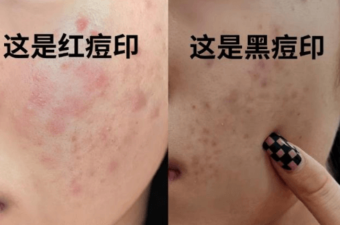 如何告别痘印与痘疤,重拾光滑肌肤?插图(1) 如何告别痘印与痘疤,重拾光滑肌肤?插图(1)