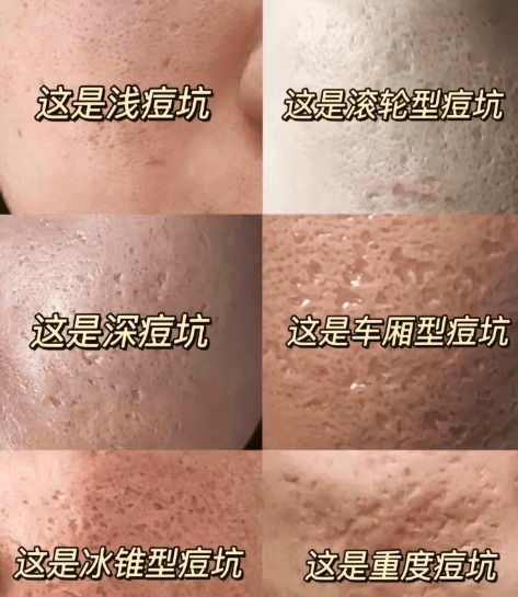 如何告别痘印与痘疤,重拾光滑肌肤?插图 如何告别痘印与痘疤,重拾光滑肌肤?插图