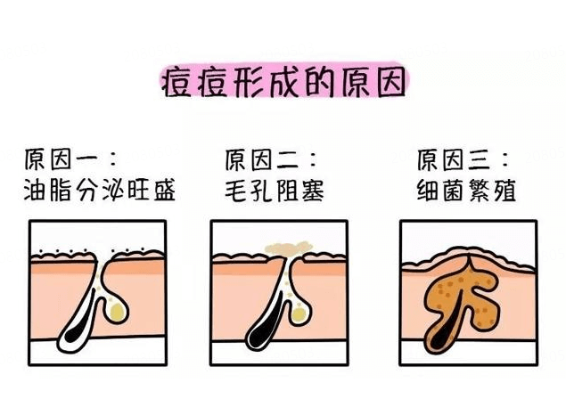 油痘肌防晒霜盲目追求“清爽感”,反而伤皮肤插图(1) 油痘肌防晒霜盲目追求“清爽感”,反而伤皮肤插图(1)