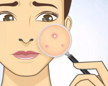 脸上反复长结节性痘痘?又硬又痛不出头怎么办 脸上反复长结节性痘痘?又硬又痛不出头怎么办